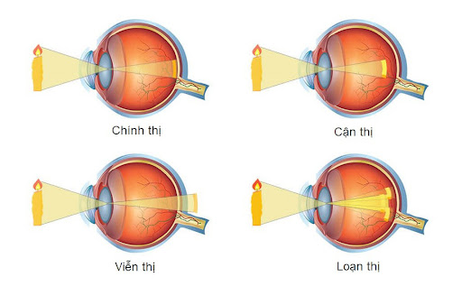 Các tật khúc xạ thường gặp: cận thị, viễn thị, loạn thị